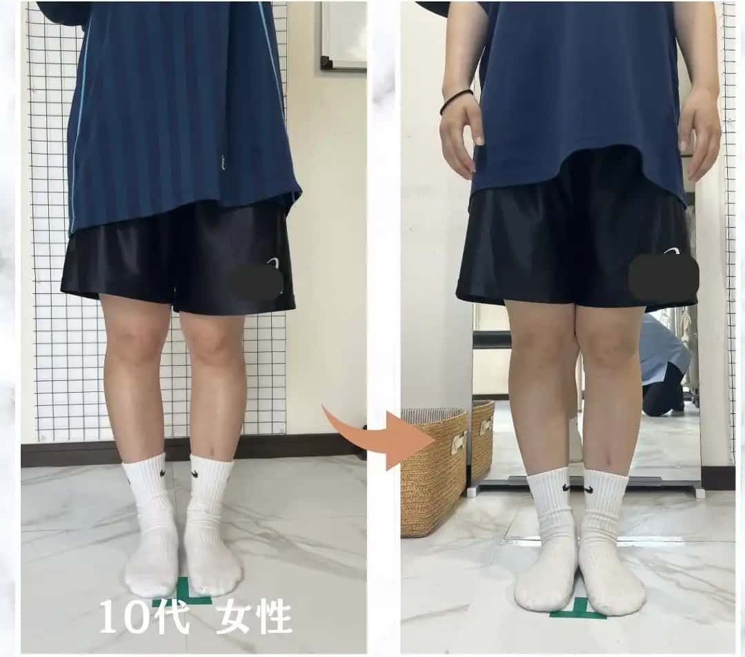 足の歪み、治らないと諦めていたあなたへ